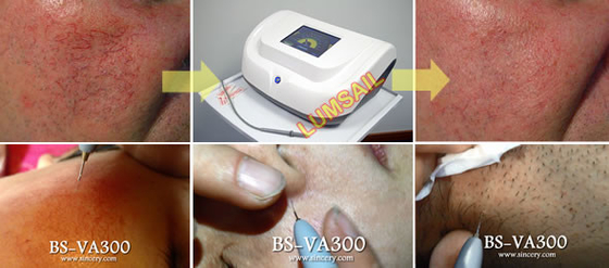Máquina de alta frequência pequena do laser da remoção da etiqueta da pele com sistema de refrigeração do fã